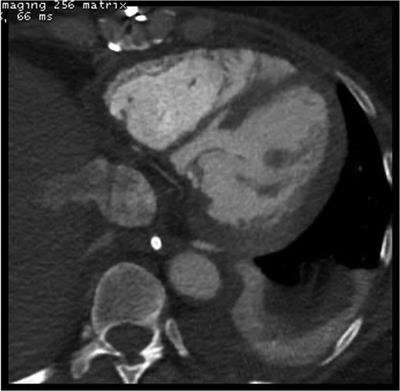 Case report: Heart transplant for persistent right heart failure after complete surgical repair and percutaneous closure of post-myocardial infarction ventricular septal rupture